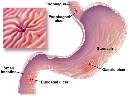 Stomach Ulcer Diagram